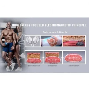 Aparat Sculptor Muscular Tesla EMS Sculpt HI-EMT + RF Remodelare corporala, Creare Masa Musculara, Tonifiere Abdomen, 4 Manipuli, Slabire intensiva NOVA4 - imagine 4