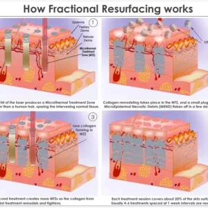 Aparat Laser Fractional Co2 Glass 10600nm, lifting, rejuvenare faciala, skin resurfacing, indepartare vergeturi7, cicatrici, anti acnee, intretinere si rejuvenare vaginala
